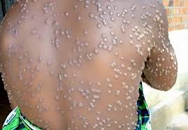 Nakuru and Border Regions Identified as Mpox Hotspots as Cases Rise